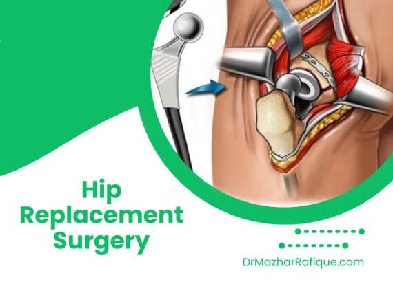 Hip replacement surgery in Lahore by Dr. Mazhar Rafique for joint pain relief